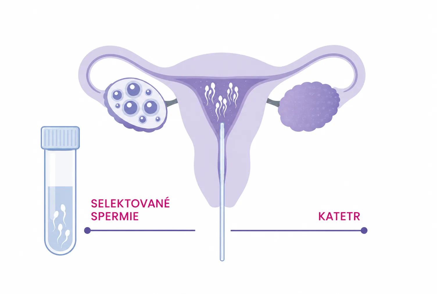 IUI